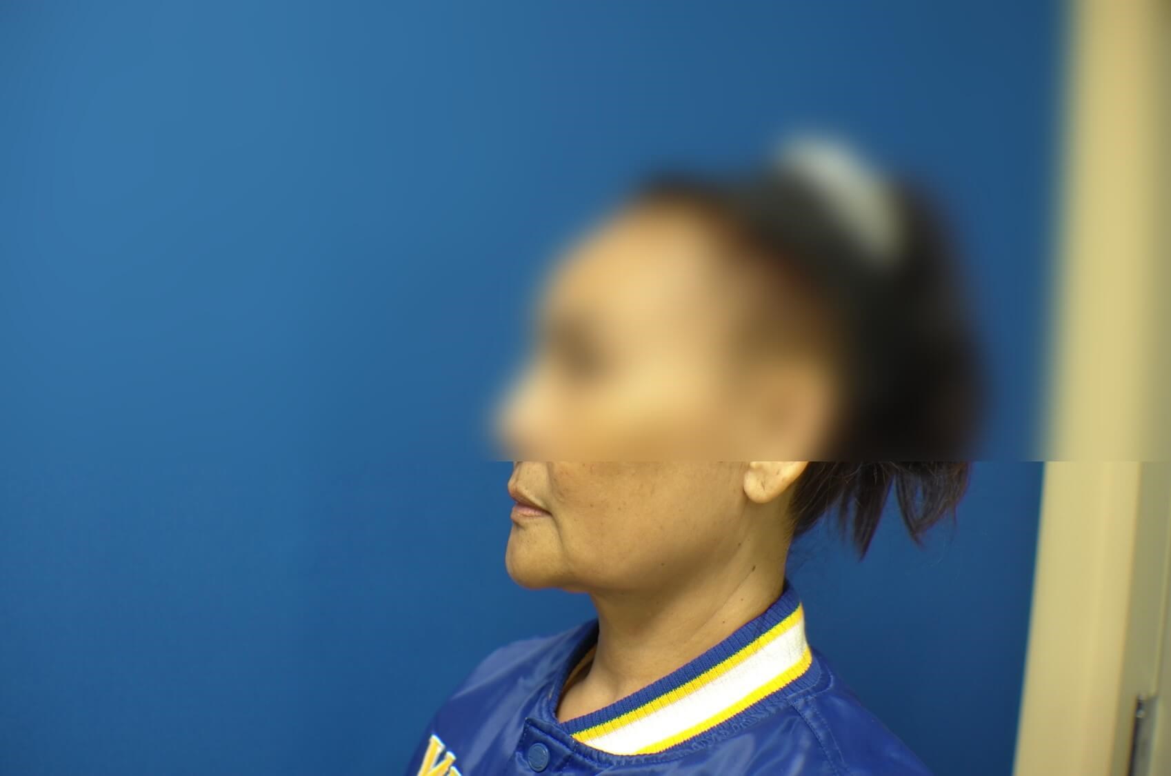 Face Lift and Neck Lift Before