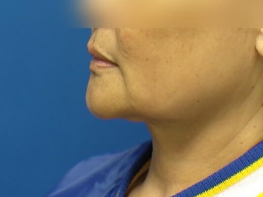 Face Lift and Neck Lift Before