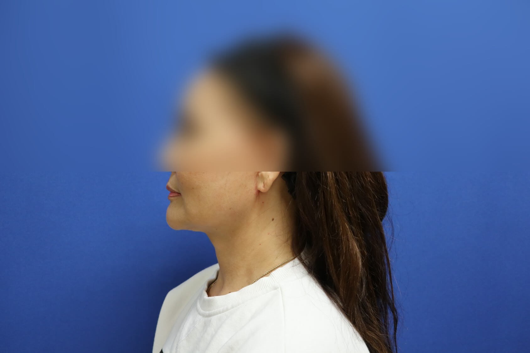 Face Lift and Neck Lift After