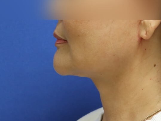 Face Lift and Neck Lift After