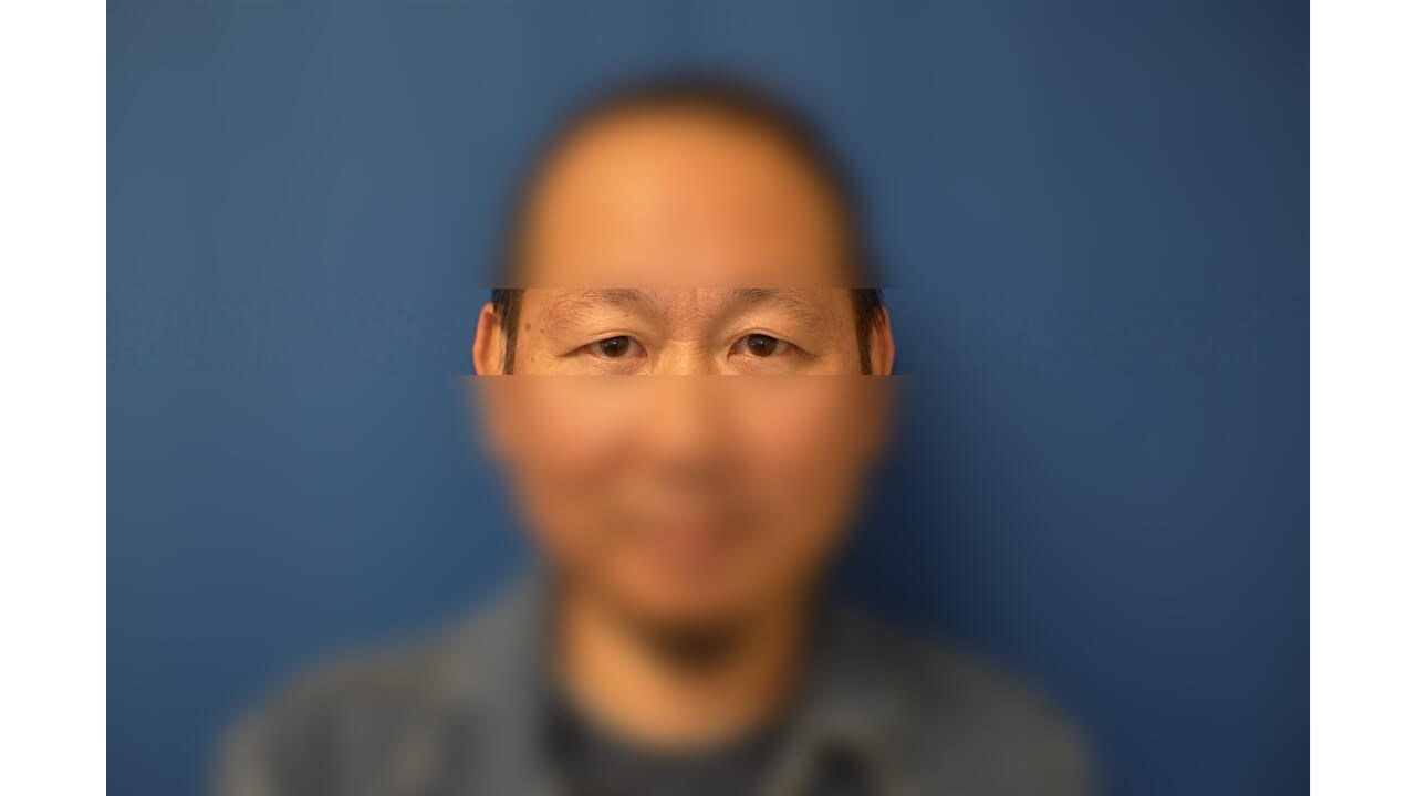 Upper Eyelid Surgery Before
