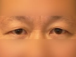 Upper Eyelid Surgery Before