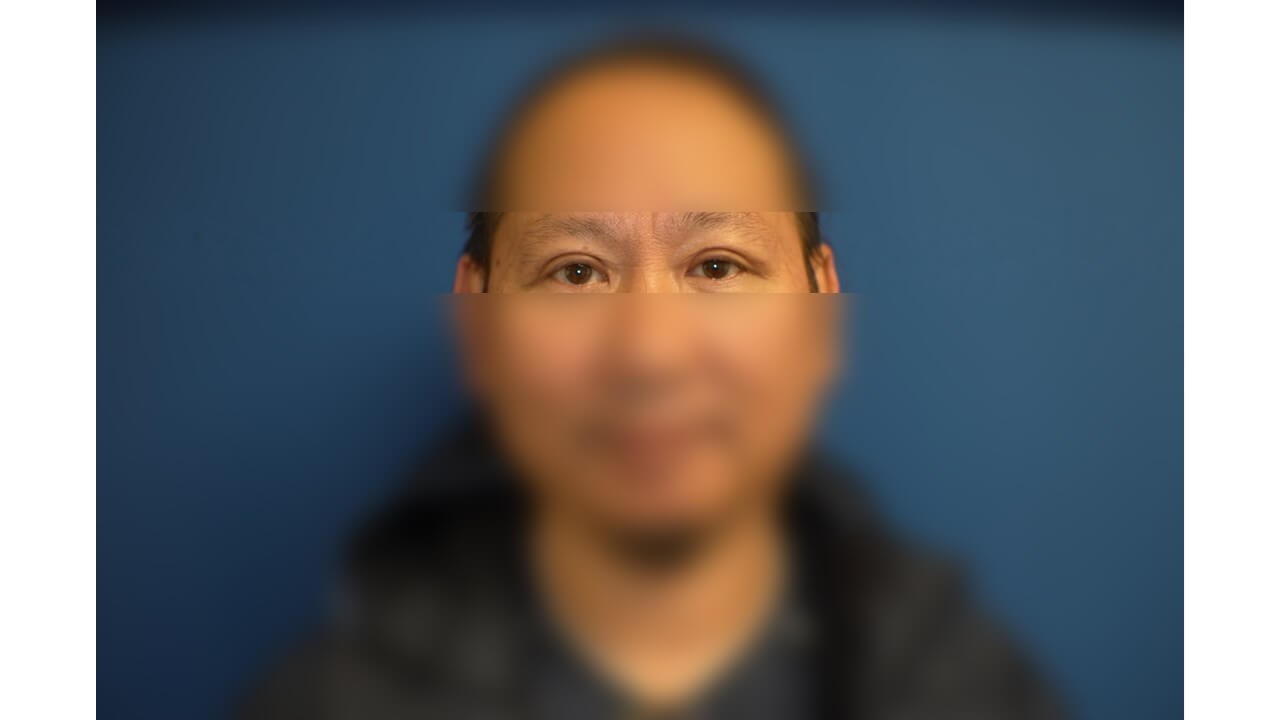 Upper Eyelid Surgery After