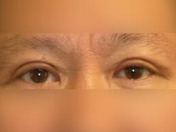 Upper Eyelid Surgery After