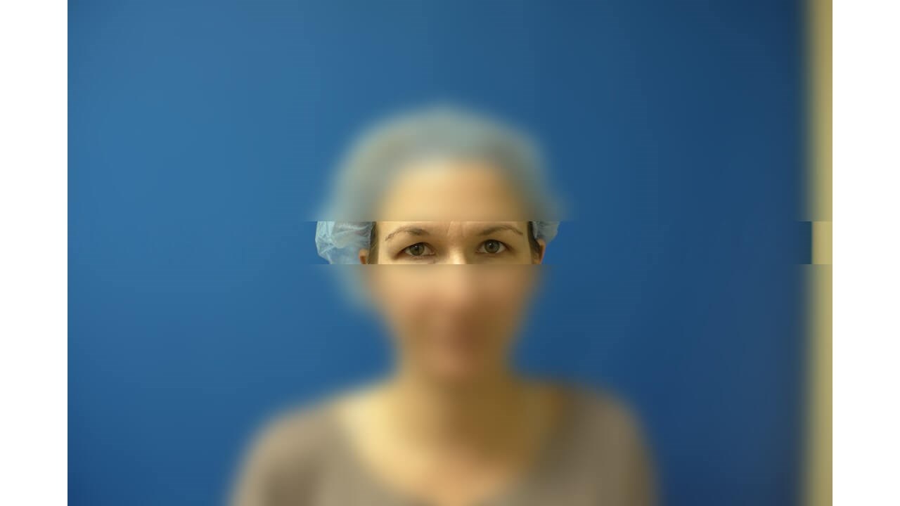 Upper Eyelid Surgery Before