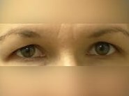 Upper Eyelid Surgery Before