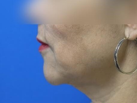 Face Lift Before