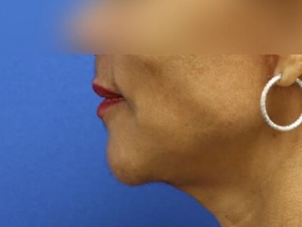 Face Lift After