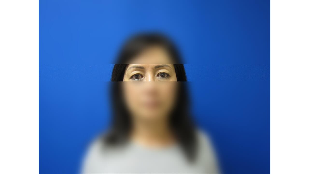 Upper Eyelid Surgery Before