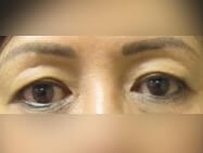 Upper Eyelid Surgery Before