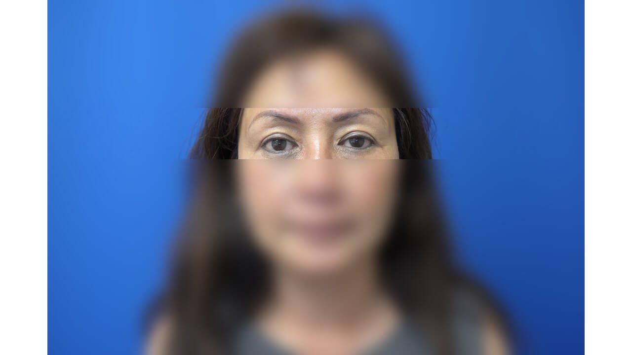 Upper Eyelid Surgery After