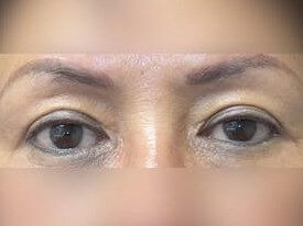 Upper Eyelid Surgery After