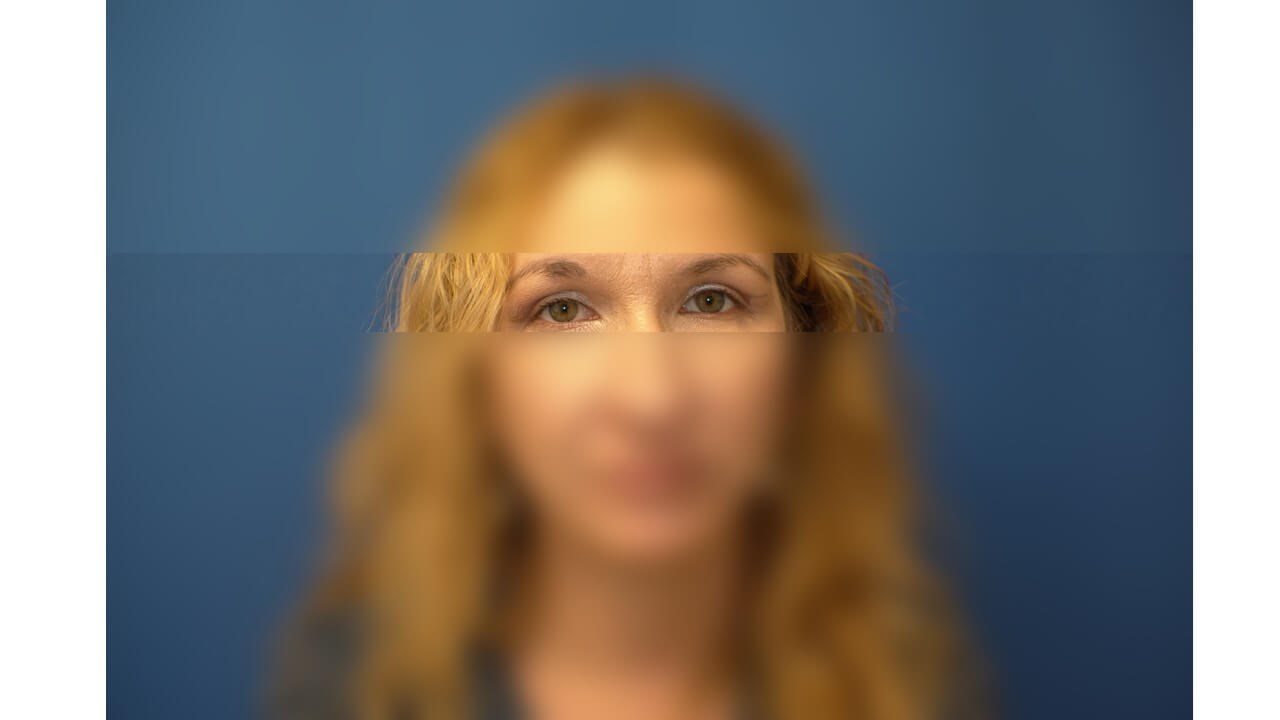 Upper Eyelid Surgery After