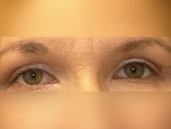 Upper Eyelid Surgery After