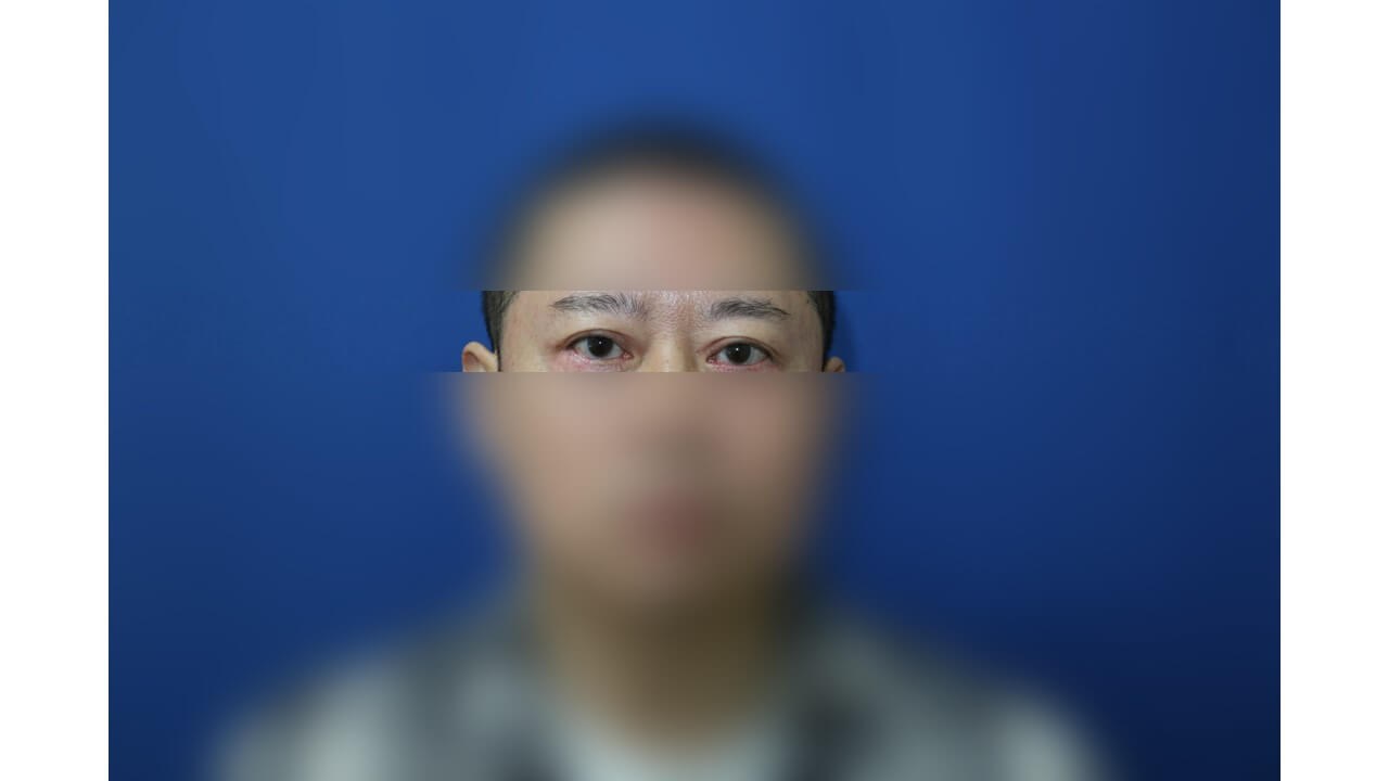 Upper Eyelid Surgery After