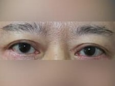 Upper Eyelid Surgery After
