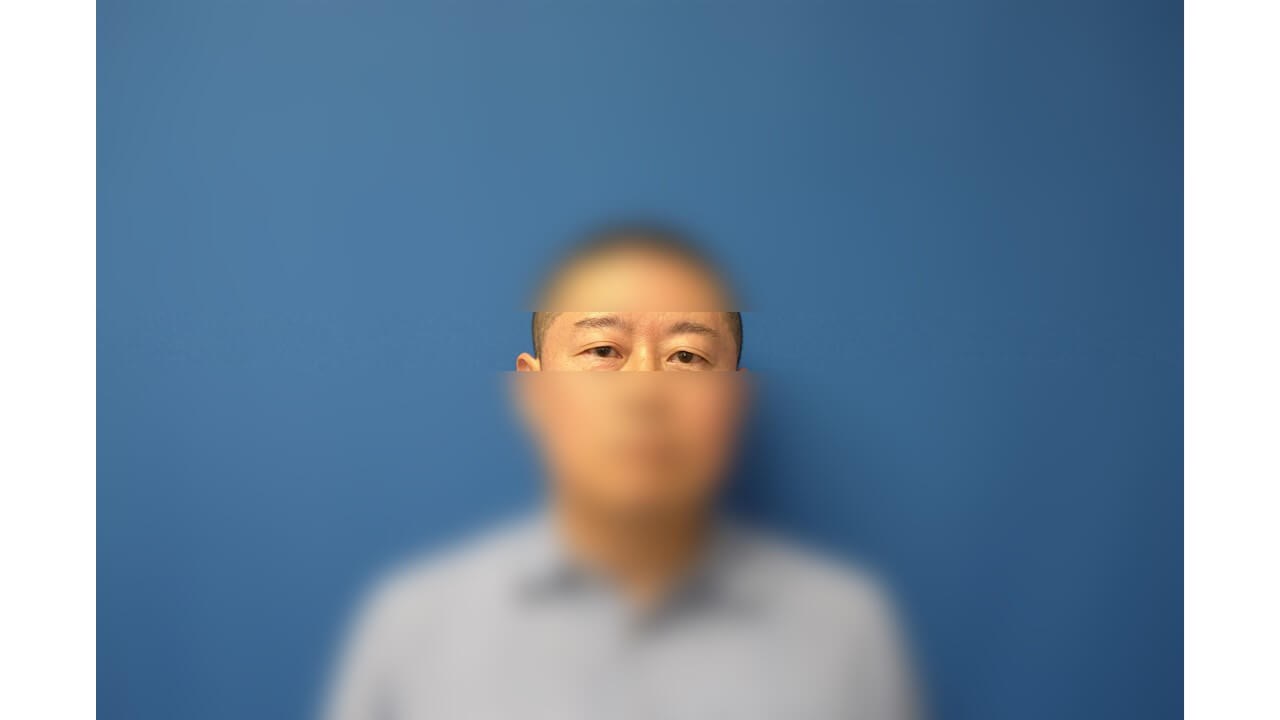 Upper Eyelid Surgery Before