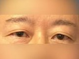 Upper Eyelid Surgery Before