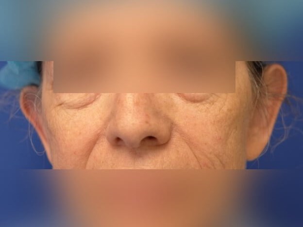 Otoplasty Before