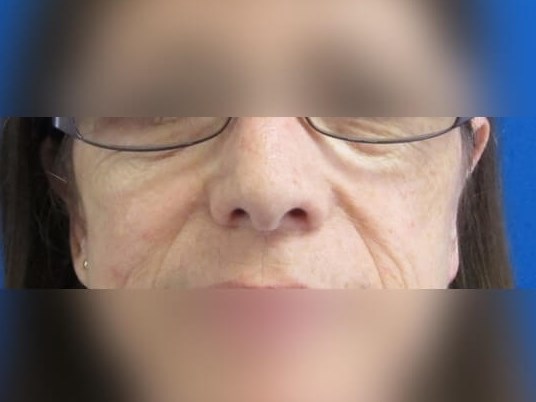 Otoplasty After
