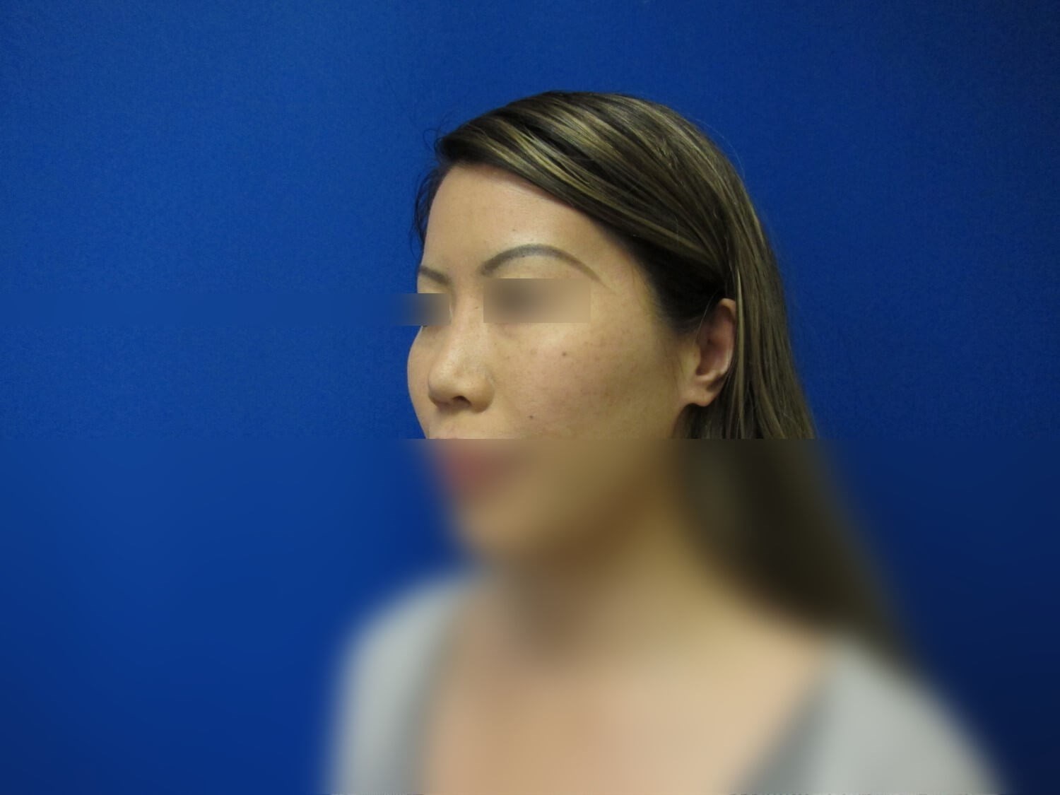 Rhinoplasty Revision Before