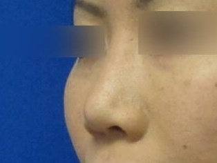 Rhinoplasty Revision Before