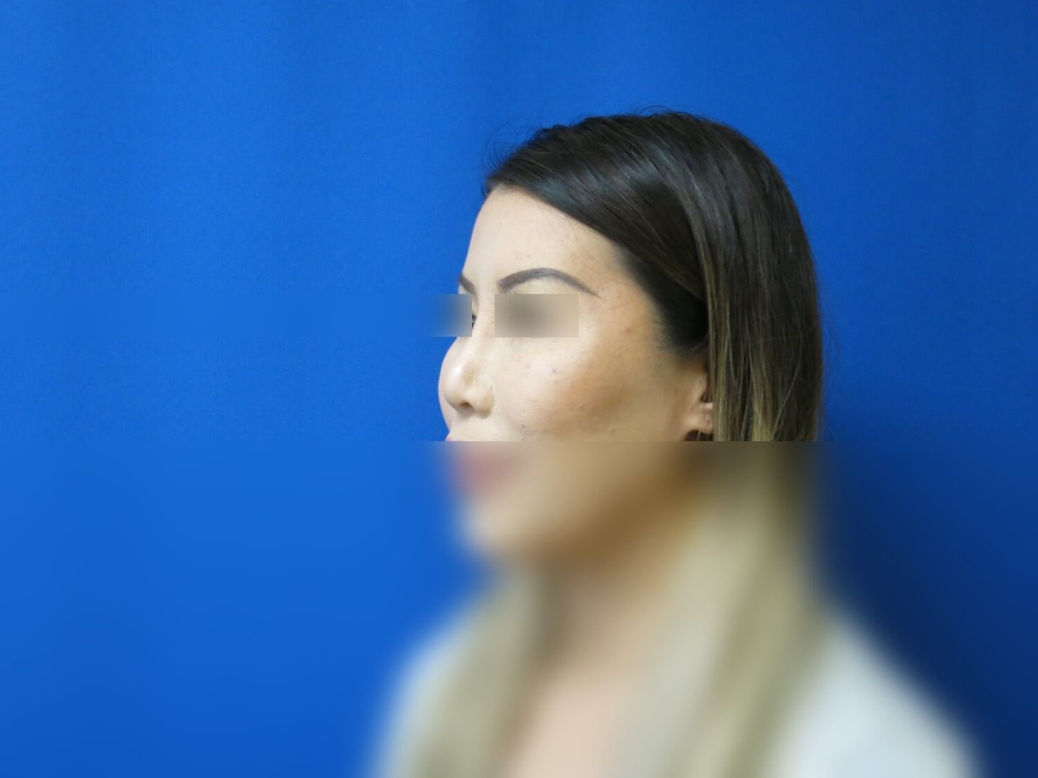Rhinoplasty Revision After