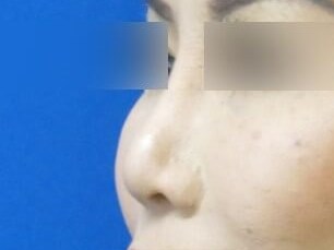 Rhinoplasty Revision After