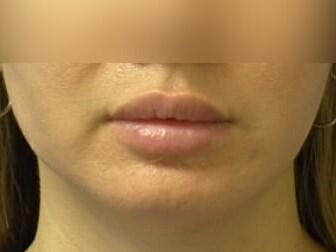 Buccal Fat Removal After
