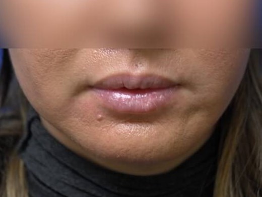 Buccal Fat Removal Before