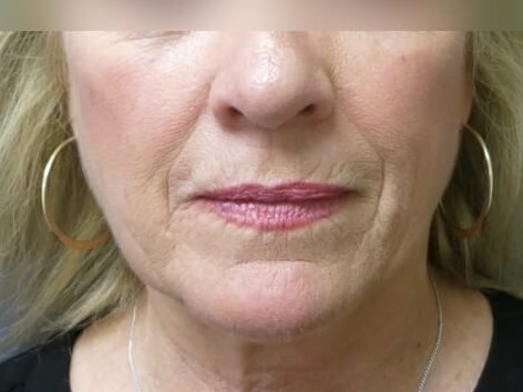 Facial Fat Graft Before