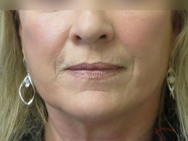 Facial Fat Graft After