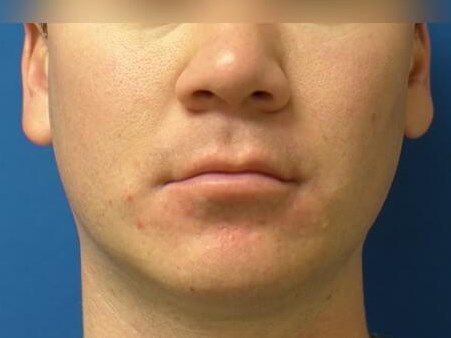 Buccal Fat Removal Before