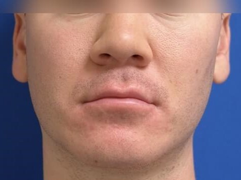 Buccal Fat Removal After