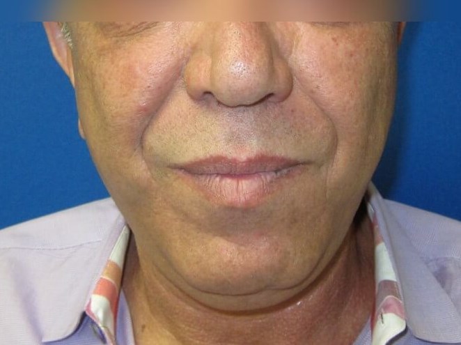 Face Lift and Facial Fat Graft After
