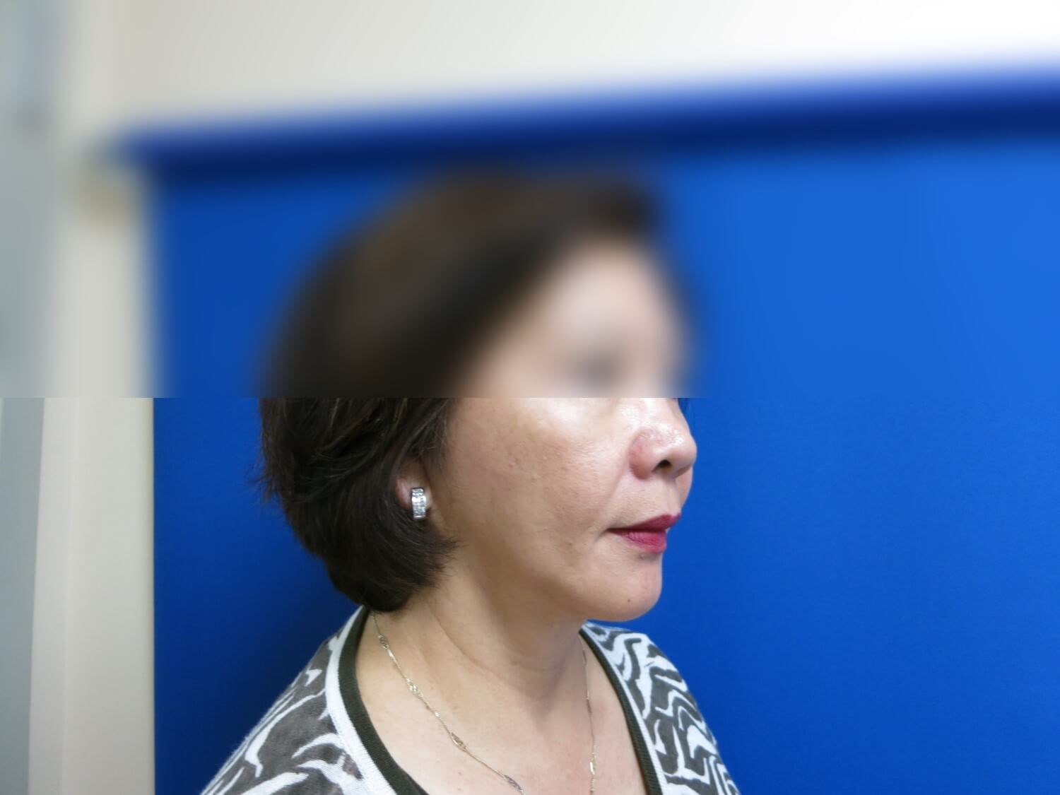 Face Lift and Facial Fat Graft After