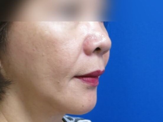 Face Lift and Facial Fat Graft After