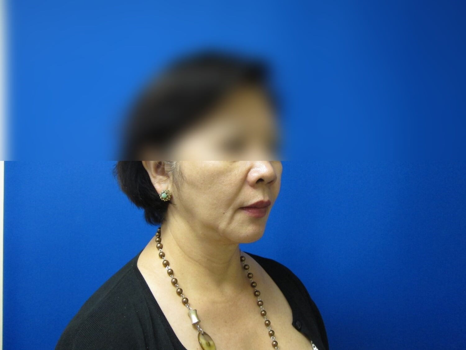 Face Lift and Facial Fat Graft Before