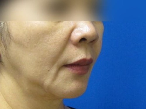 Face Lift and Facial Fat Graft Before