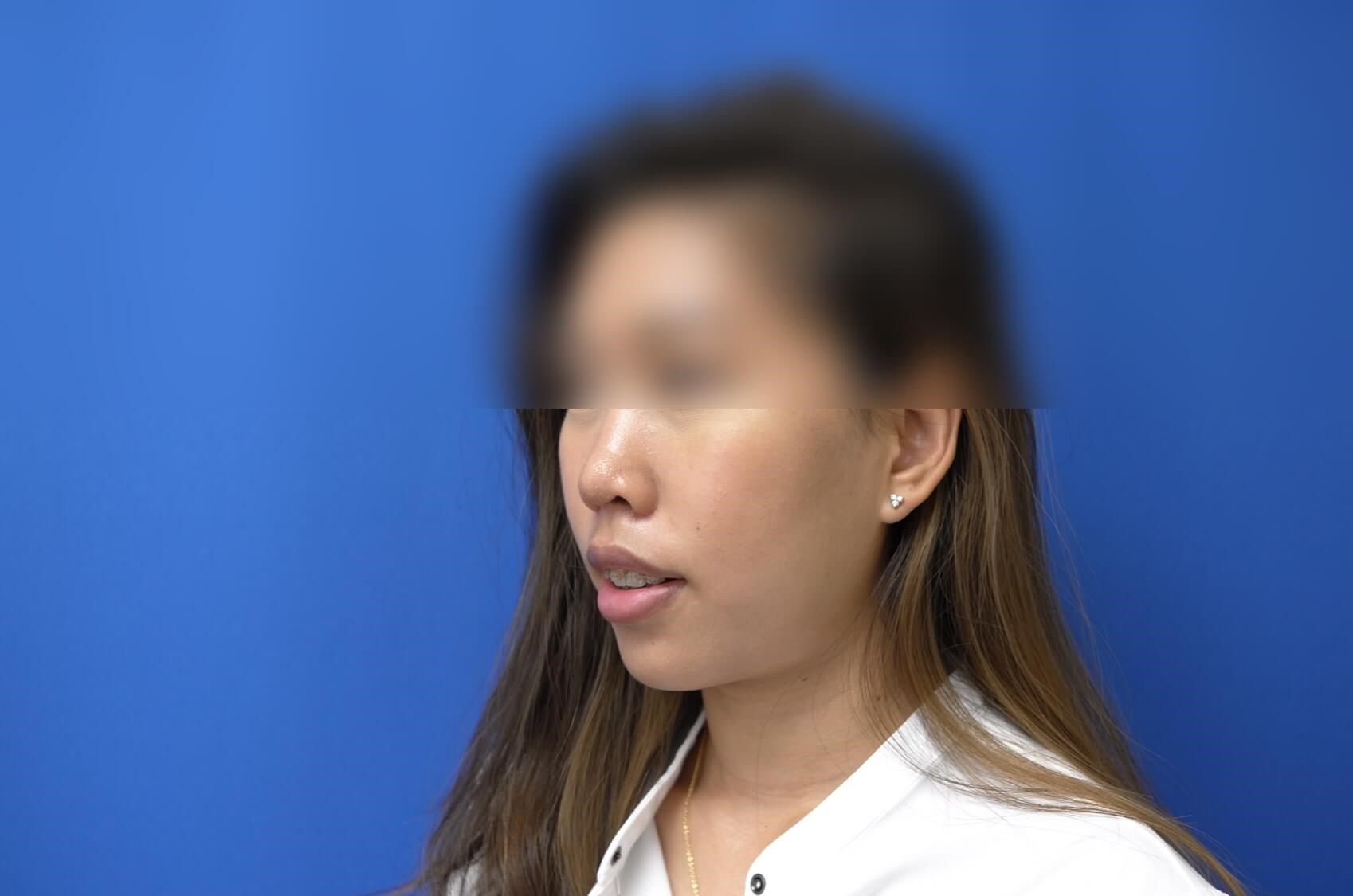 Rhinoplasty After