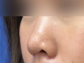 Rhinoplasty After
