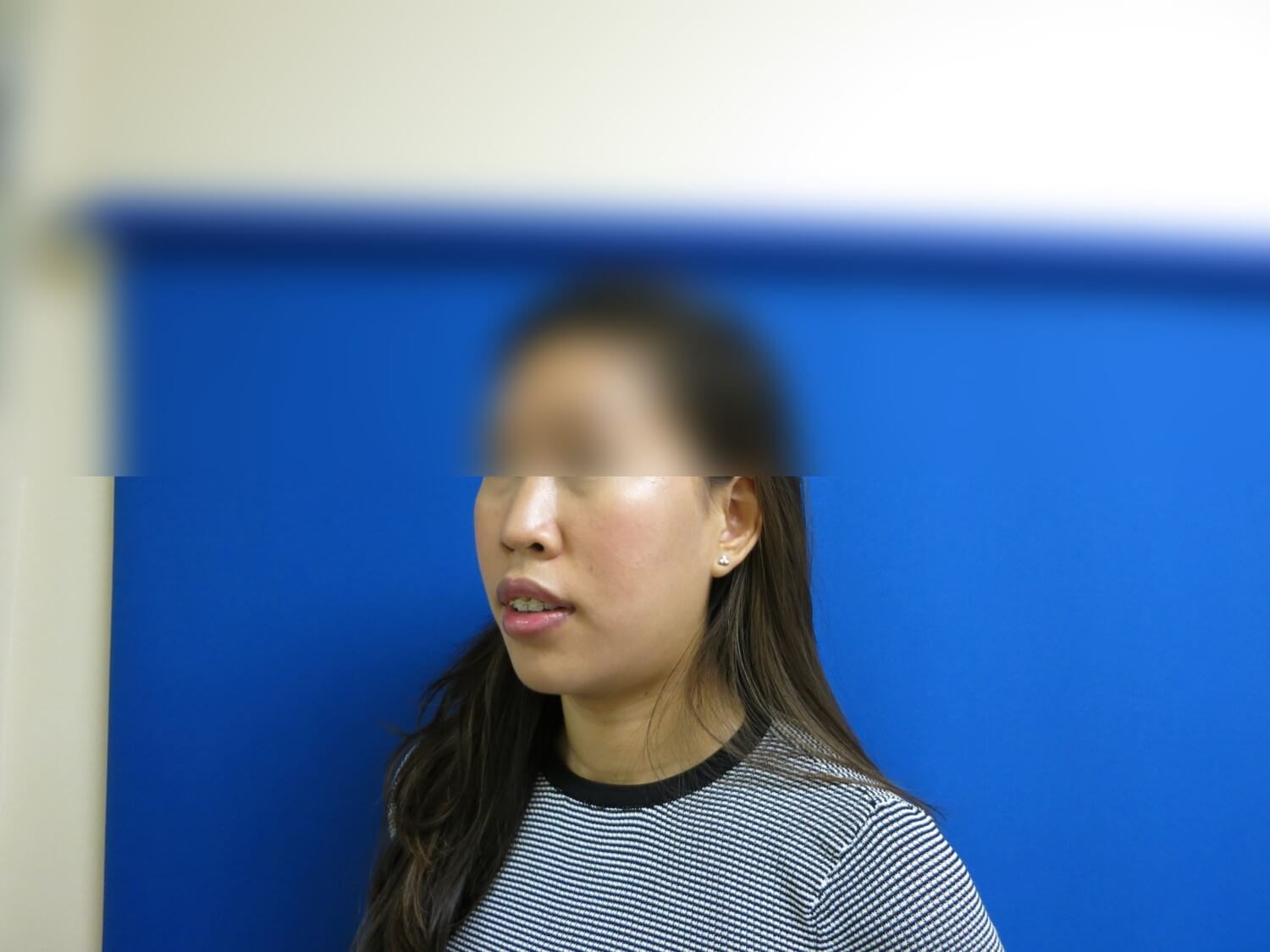 Rhinoplasty Before