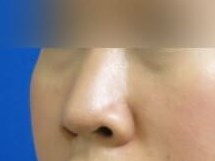 Rhinoplasty Before