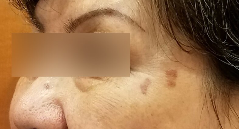 Laser Skin Toning Before