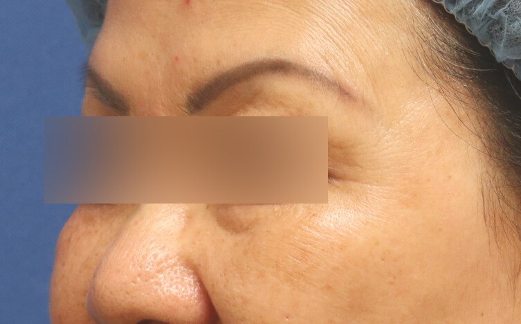 Laser Skin Toning After