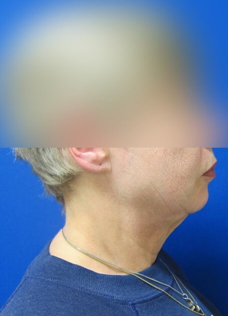 Neck Lift Before