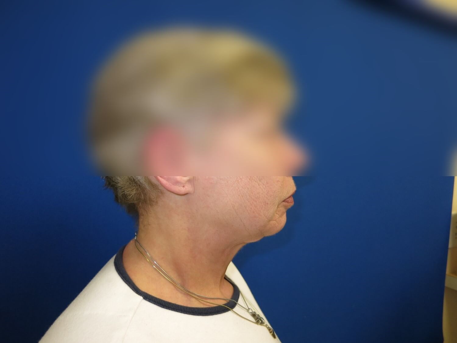 Neck Lift After
