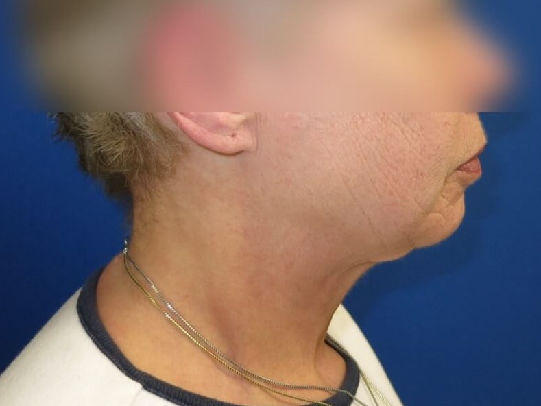 Neck Lift After