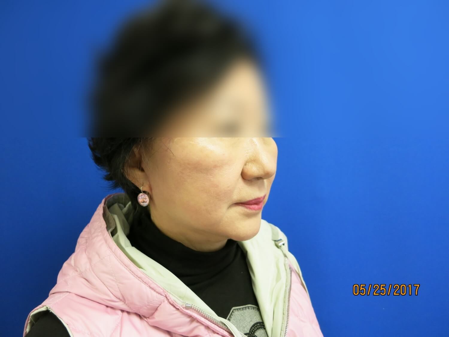 Face Lift After
