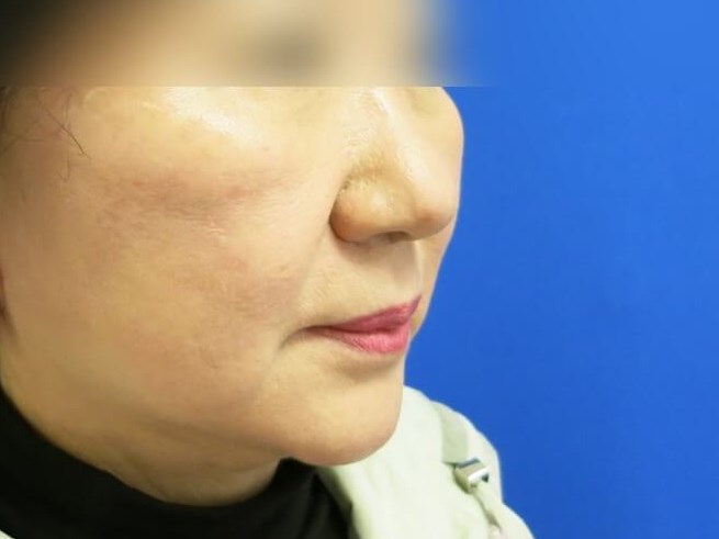 Face Lift After